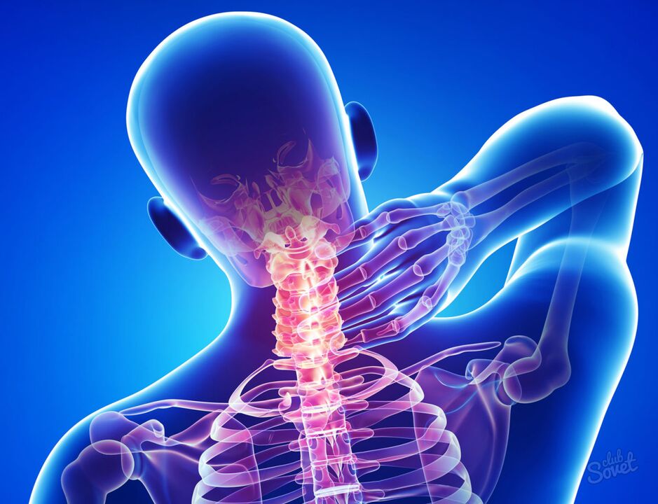 Osteohondroza materničnega vratu