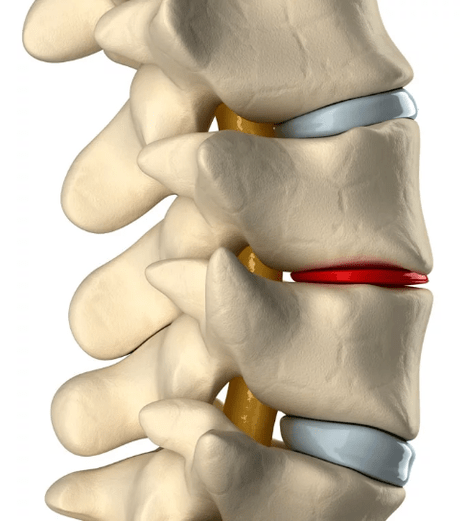 Osteohondroza torakalne hrbtenice