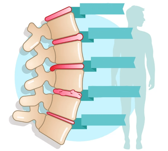 Stopnja bolezni torakalne osteohondroze