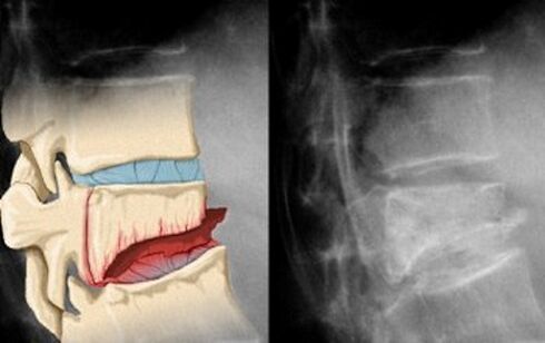 Razpoke v medvretenčnih diskih na prvi stopnji vratne osteohondroze