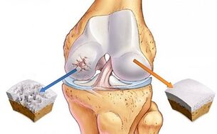 zdrav hrustanec in artroza kolenskega sklepa