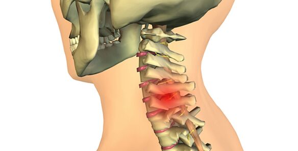 spremembe v hrbtenici s cervikalno osteohondrozo
