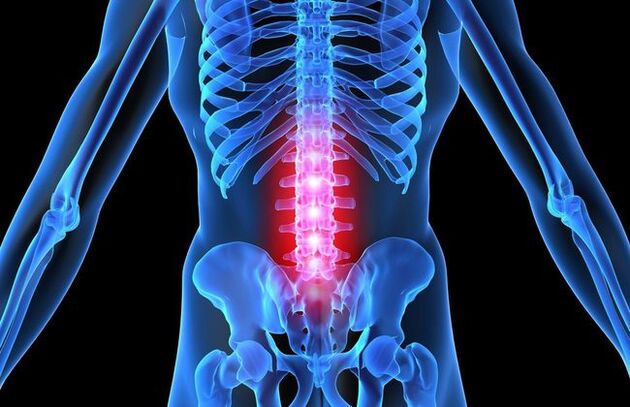 V napredni fazi osteohondroze ledvene hrbtenice se motorična aktivnost osebe poslabša. 